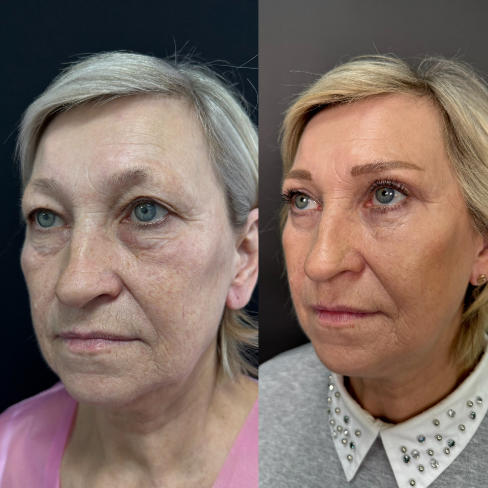 Блефаропластика верхних и нижних век . Фото до и после , фотография 2