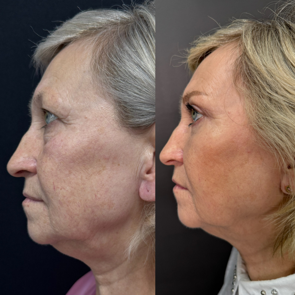 Блефаропластика верхних и нижних век . Фото до и после , фотография 3