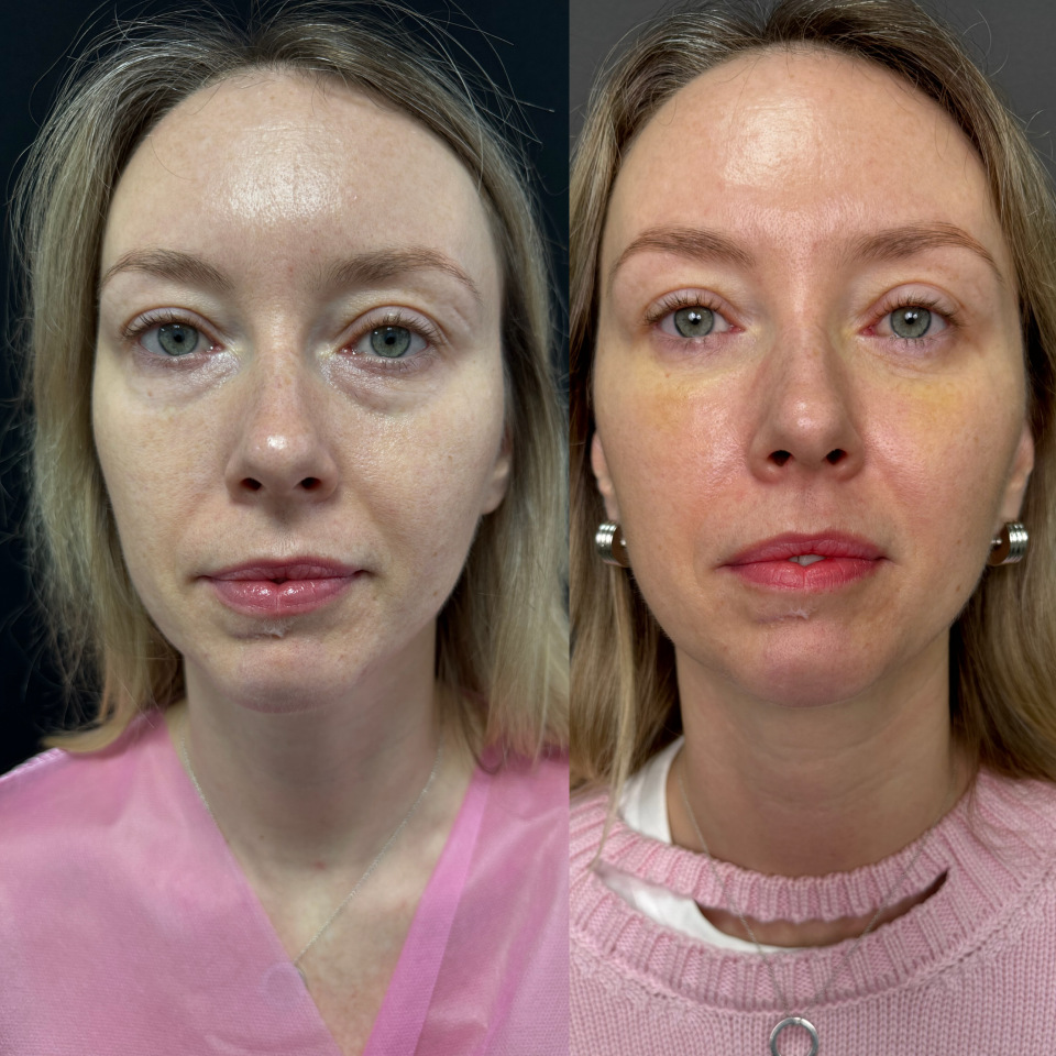 Блефаропластика без шва . Фото до и после , фотография 1