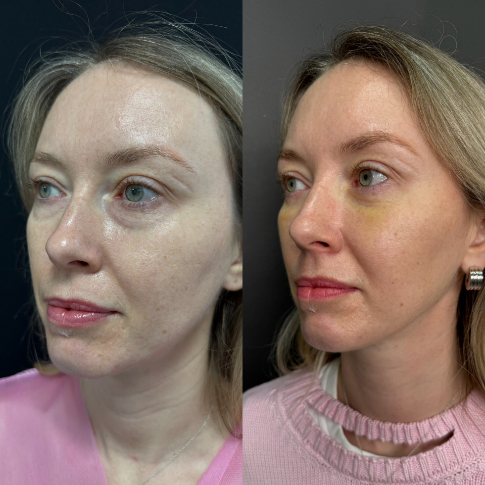 Блефаропластика без шва . Фото до и после , фотография 2