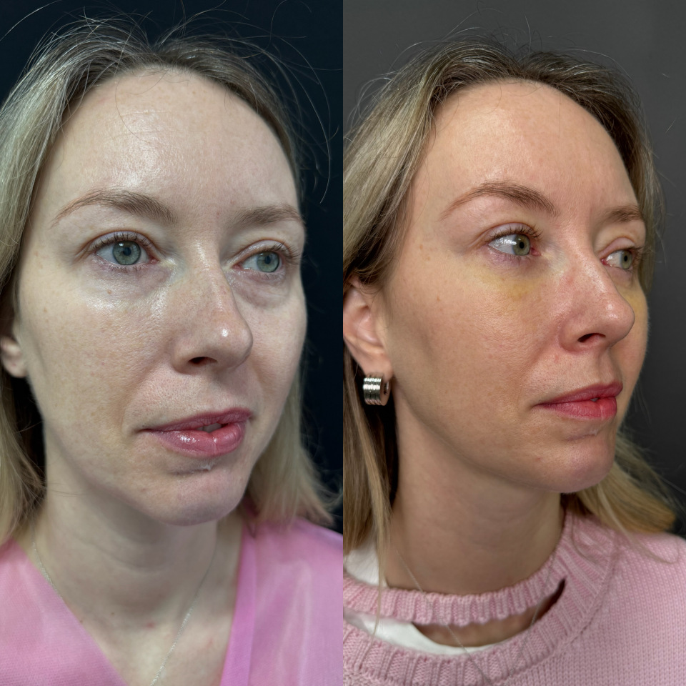 Блефаропластика без шва . Фото до и после , фотография 3