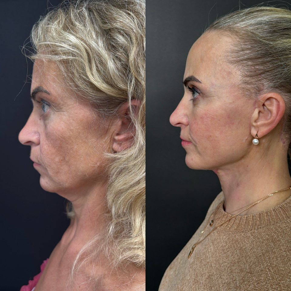 Фейслифтинг . Фото до и после , фотография 3