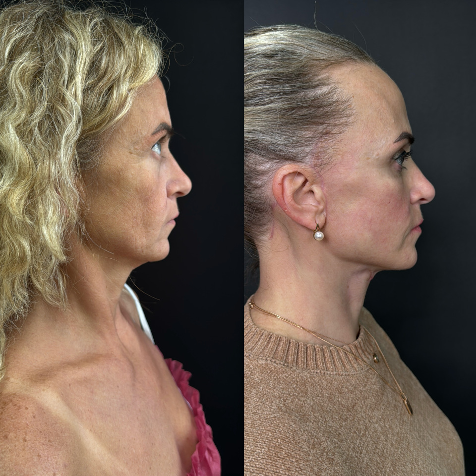 Фейслифтинг . Фото до и после , фотография 7