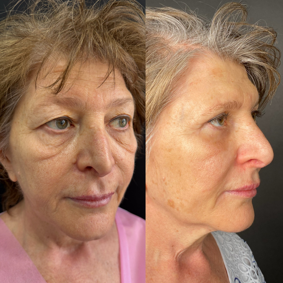 Блефаропластика верхних и нижних век . Фото до и после , фотография 3