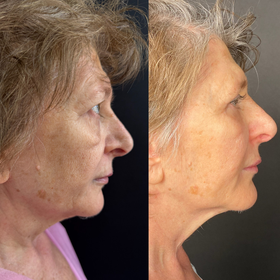 Блефаропластика верхних и нижних век . Фото до и после , фотография 5