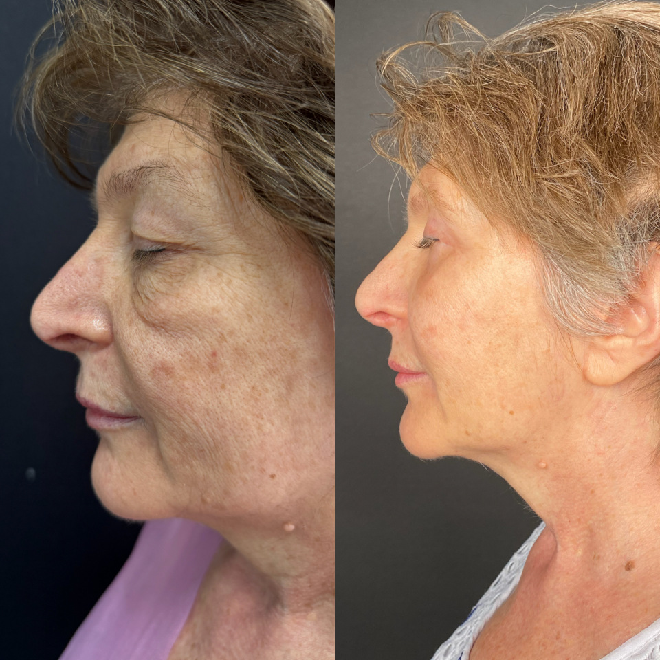 Блефаропластика верхних и нижних век . Фото до и после , фотография 6