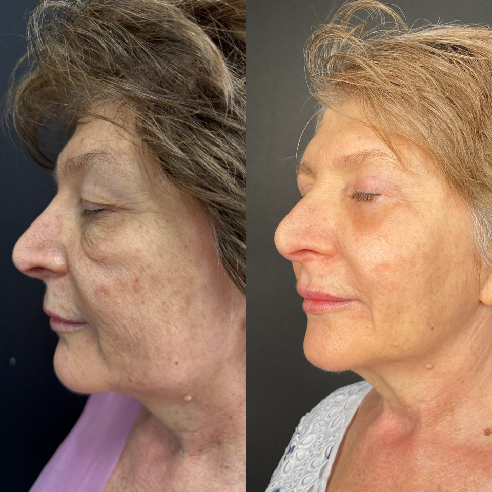 Блефаропластика верхних и нижних век . Фото до и после , фотография 9