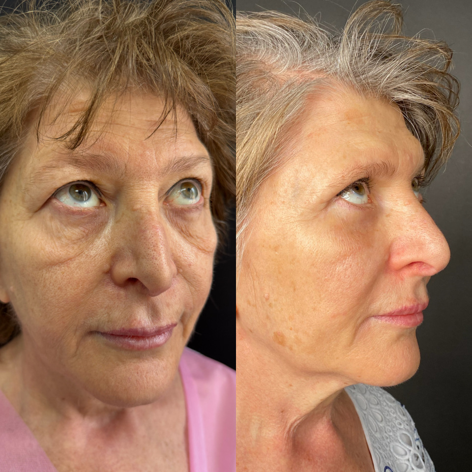 Блефаропластика верхних и нижних век . Фото до и после , фотография 11