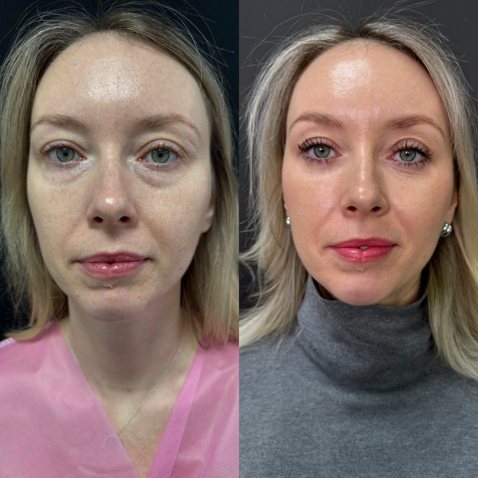 Блефаропластика без шва . Фото до и после , фотография 4