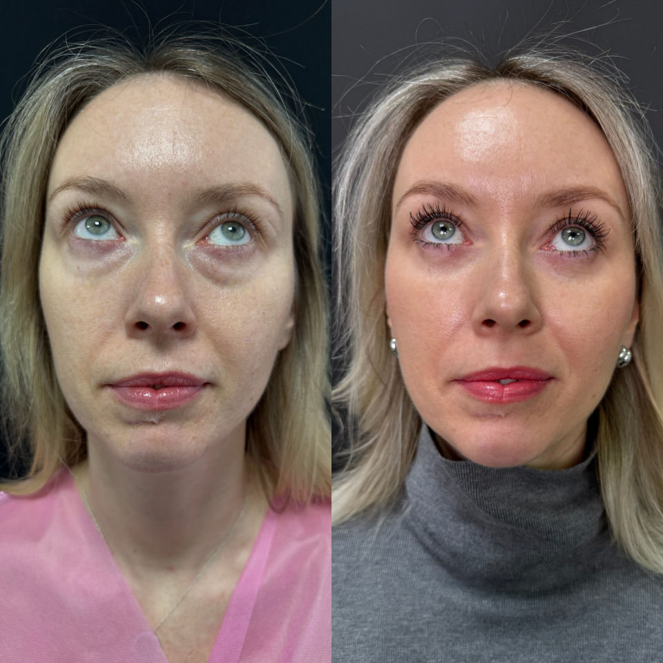 Блефаропластика без шва . Фото до и после , фотография 5