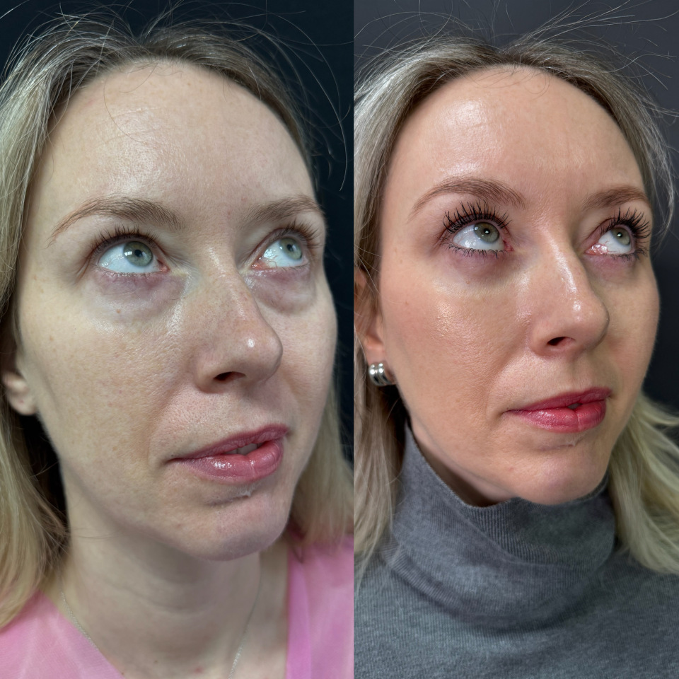 Блефаропластика без шва . Фото до и после , фотография 9