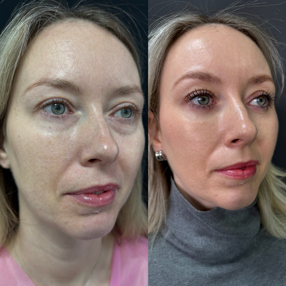 Блефаропластика без шва . Фото до и после , фотография 10