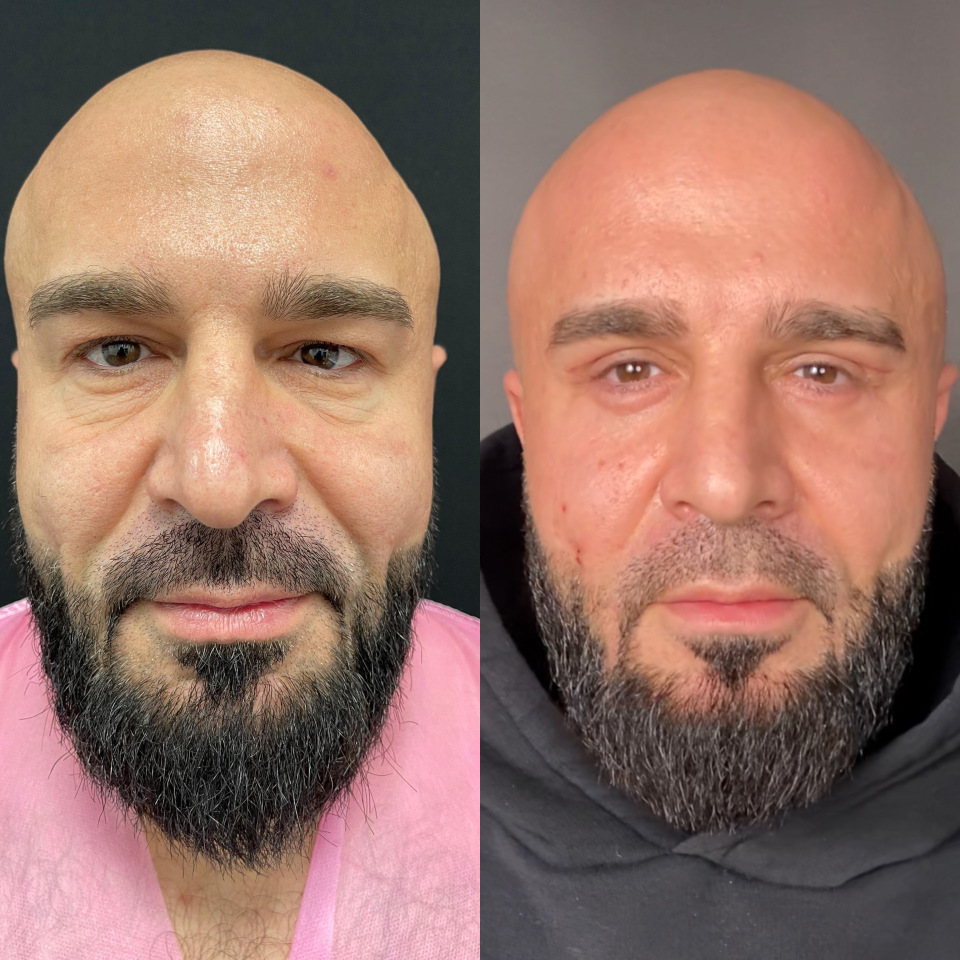 Блефаропластика верхних и нижних век . Фото до после , фотография 1