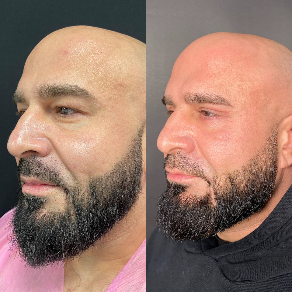 Блефаропластика верхних и нижних век . Фото до после , фотография 2