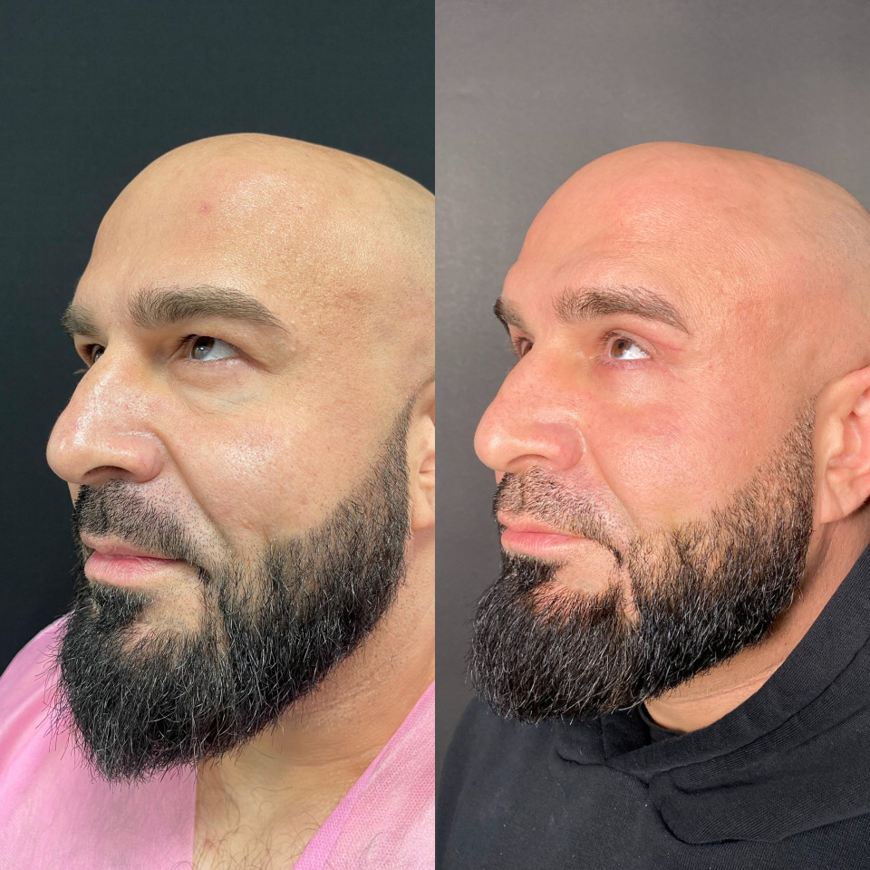 Блефаропластика верхних и нижних век . Фото до после , фотография 3