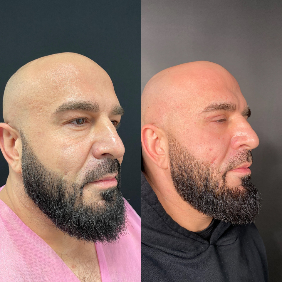 Блефаропластика верхних и нижних век . Фото до после , фотография 4