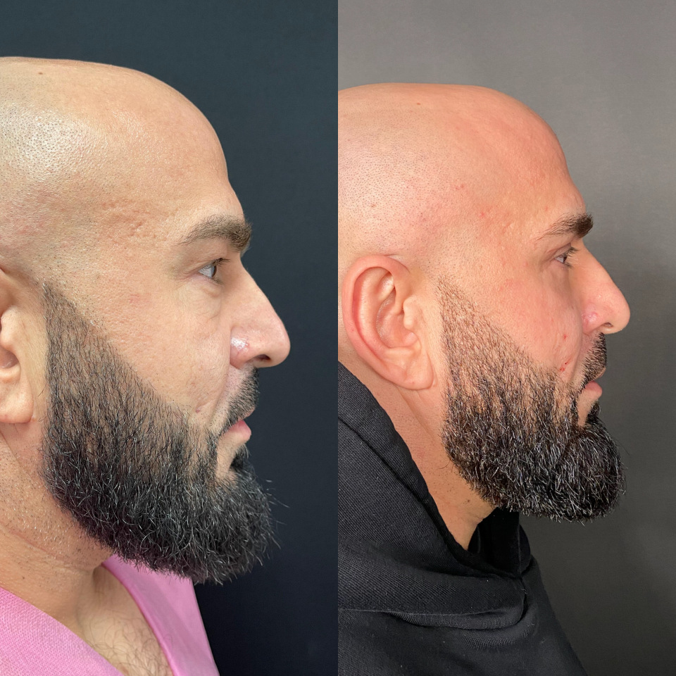 Блефаропластика верхних и нижних век . Фото до после , фотография 5