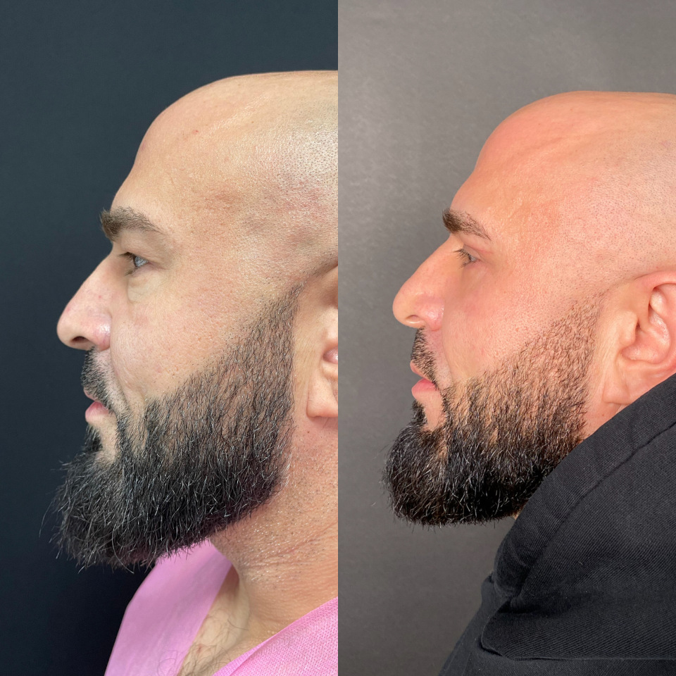 Блефаропластика верхних и нижних век . Фото до после , фотография 6