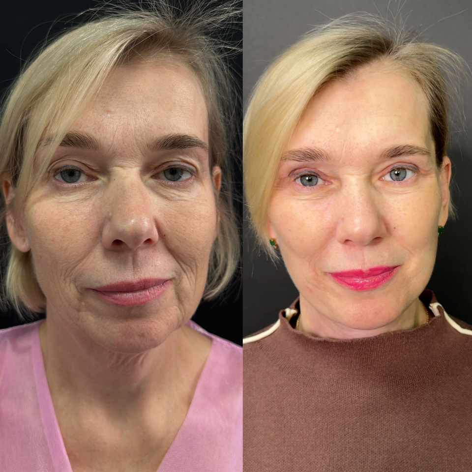 Подтяжка лица и шеи . Фото до после , фотография 1