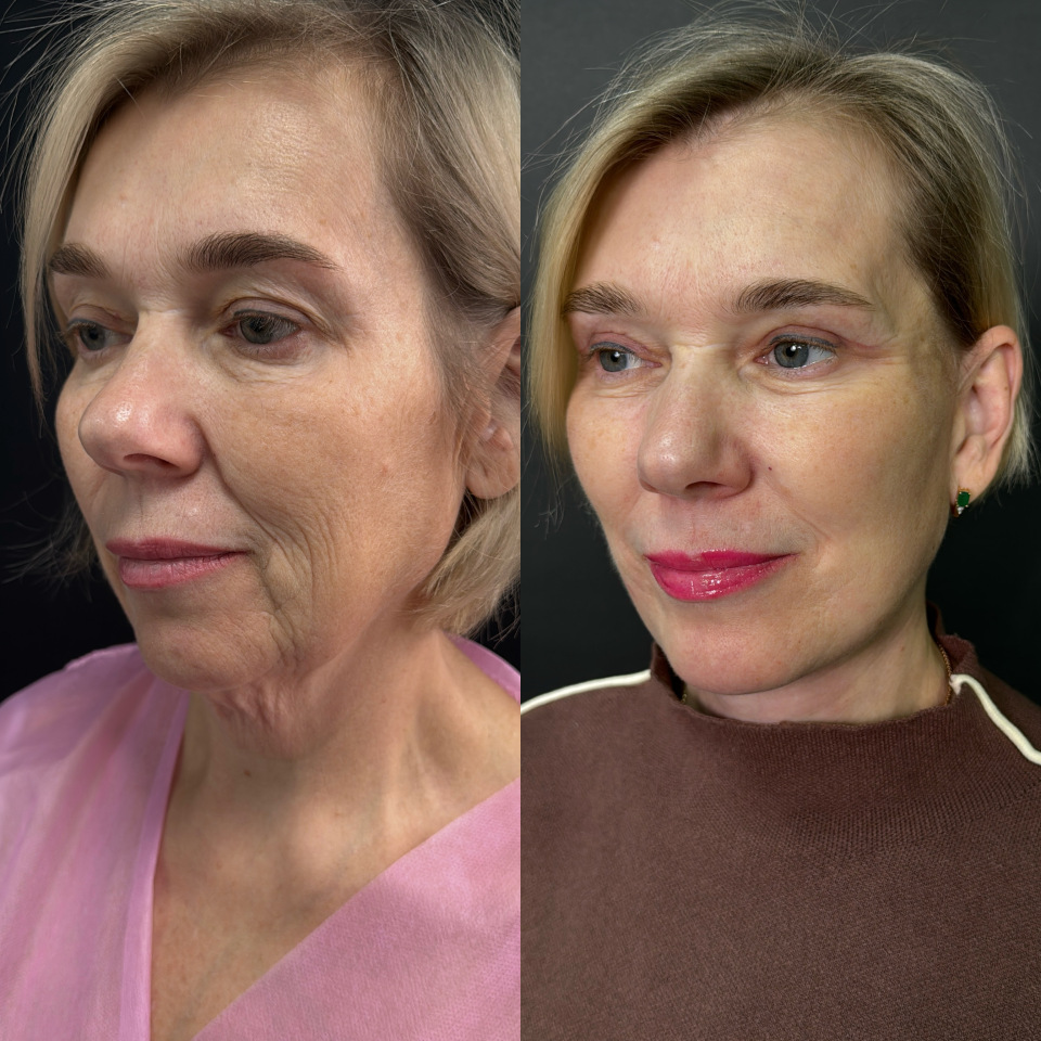 Подтяжка лица и шеи . Фото до после , фотография 3