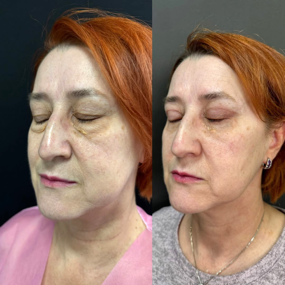 Пластика верхних и нижних век. До и После, фотография 2