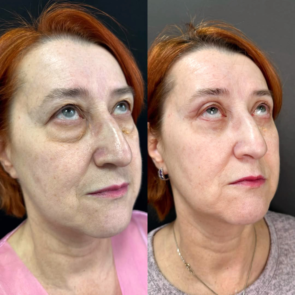 Пластика верхних и нижних век. До и После, фотография 4