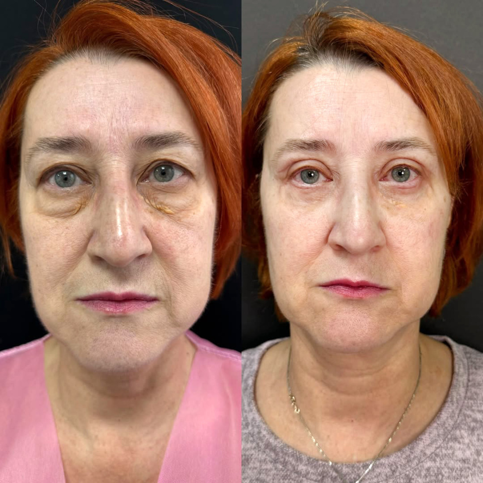 Пластика верхних и нижних век. До и После, фотография 5