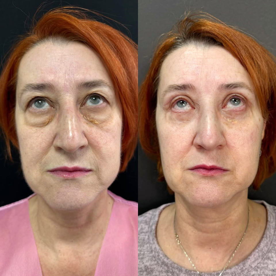 Пластика верхних и нижних век. До и После, фотография 6