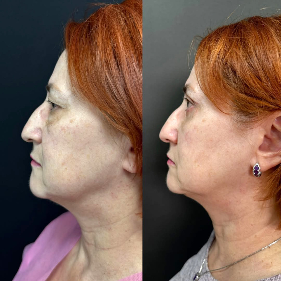 Пластика верхних и нижних век. До и После, фотография 7