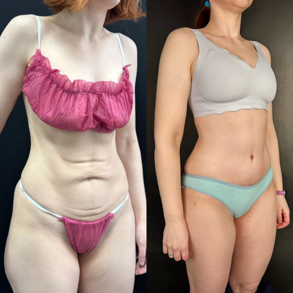 Результат абдоминопластики для спортивной пациентки, фотография 1