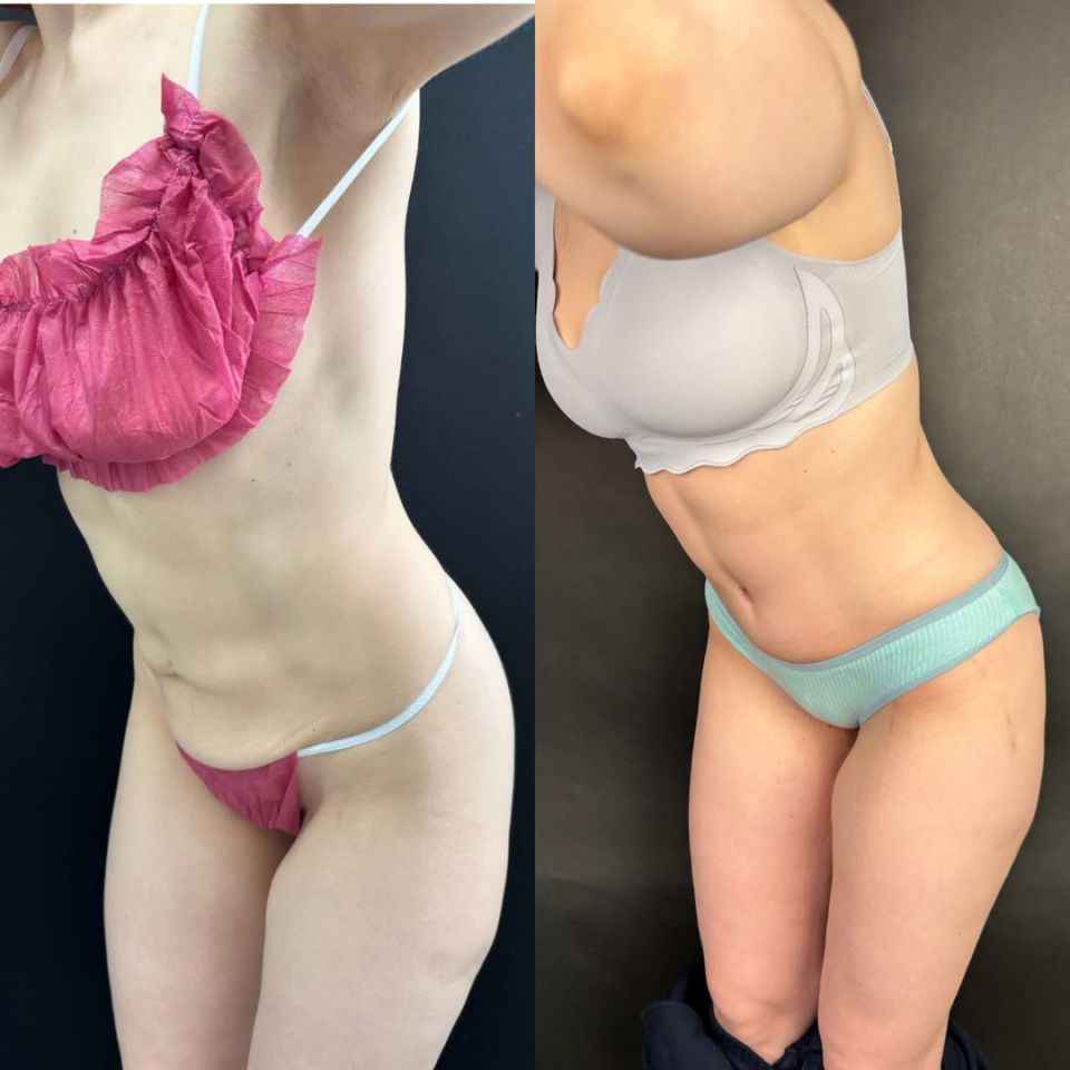 Результат абдоминопластики для спортивной пациентки, фотография 3
