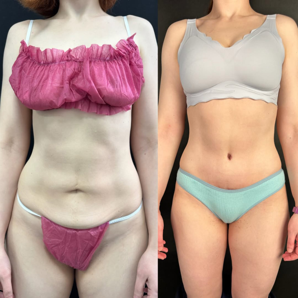 Результат абдоминопластики для спортивной пациентки, фотография 4