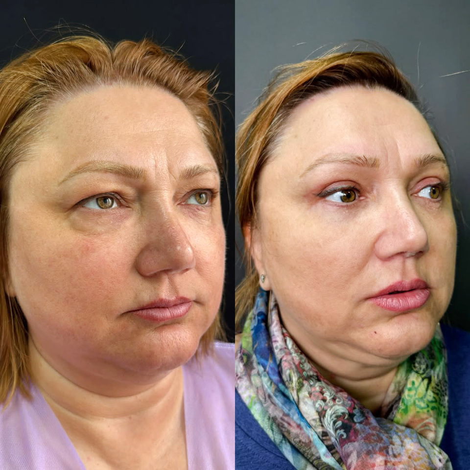 7 месяцев после круговой пластики век, фотография 1