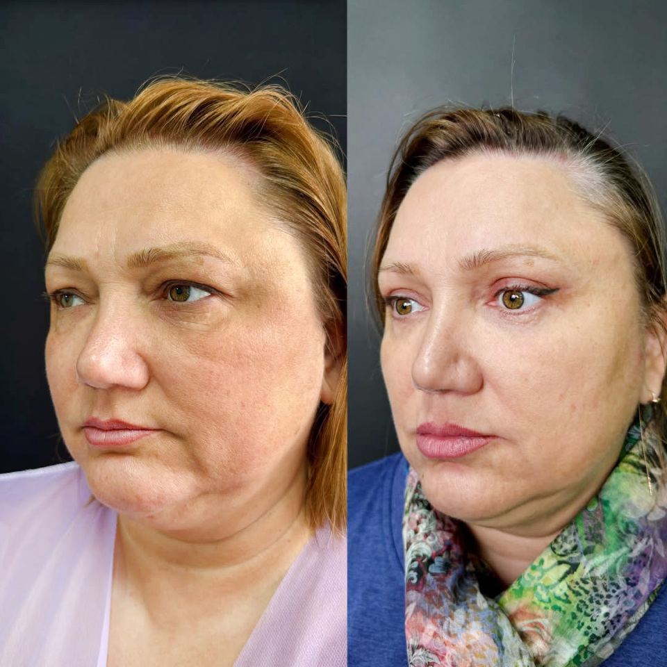 7 месяцев после круговой пластики век, фотография 2