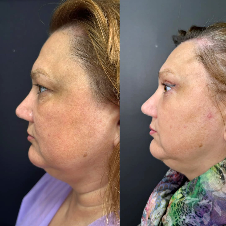 7 месяцев после круговой пластики век, фотография 4