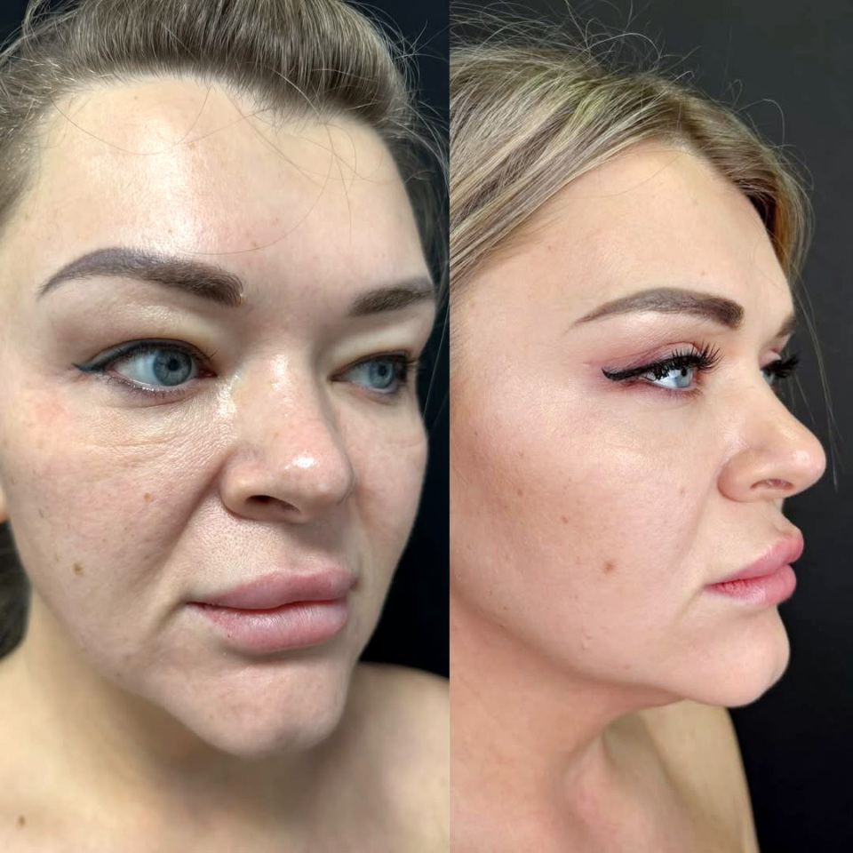 Пластика верхних век, до и после, фотография 1