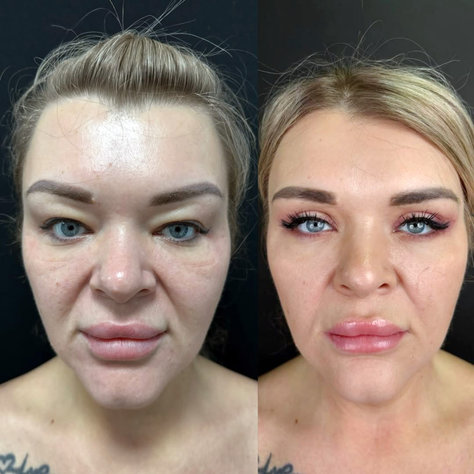 Пластика верхних век, до и после, фотография 2