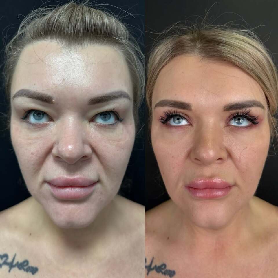 Пластика верхних век, до и после, фотография 3