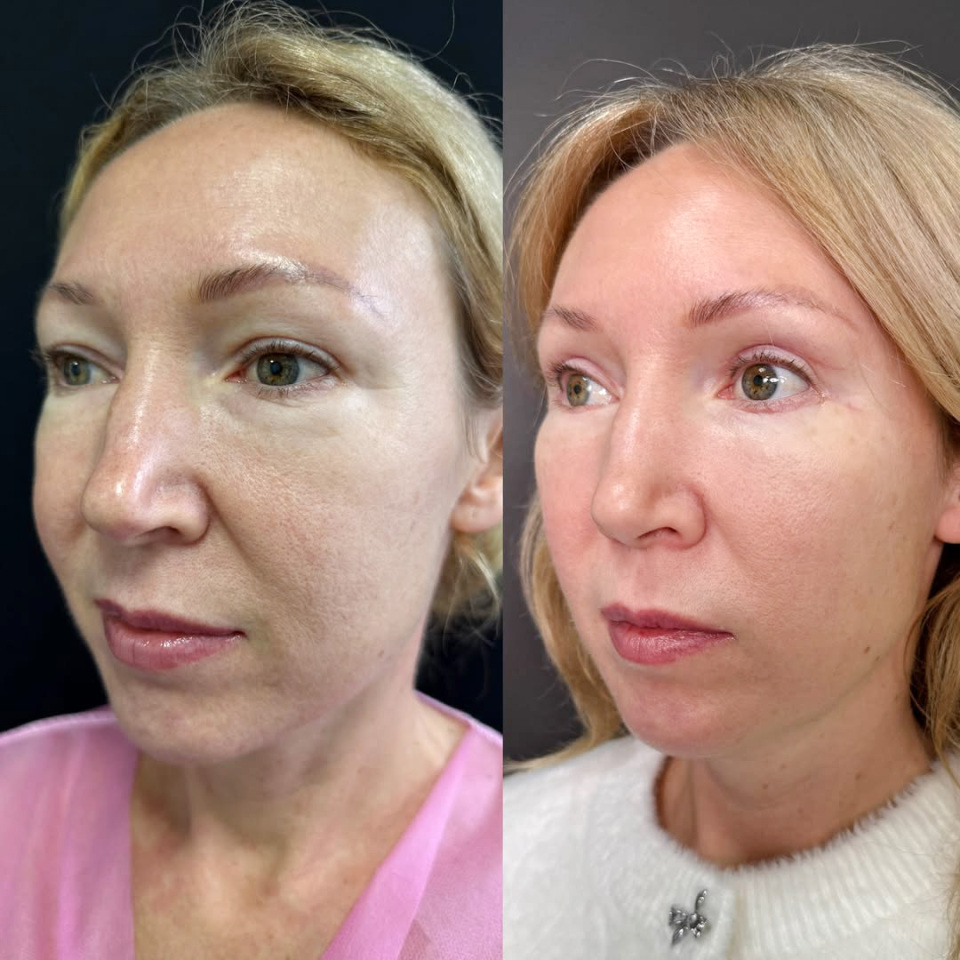 Эндоскопическая подтяжка лица результат через 2 месяца, фотография 1