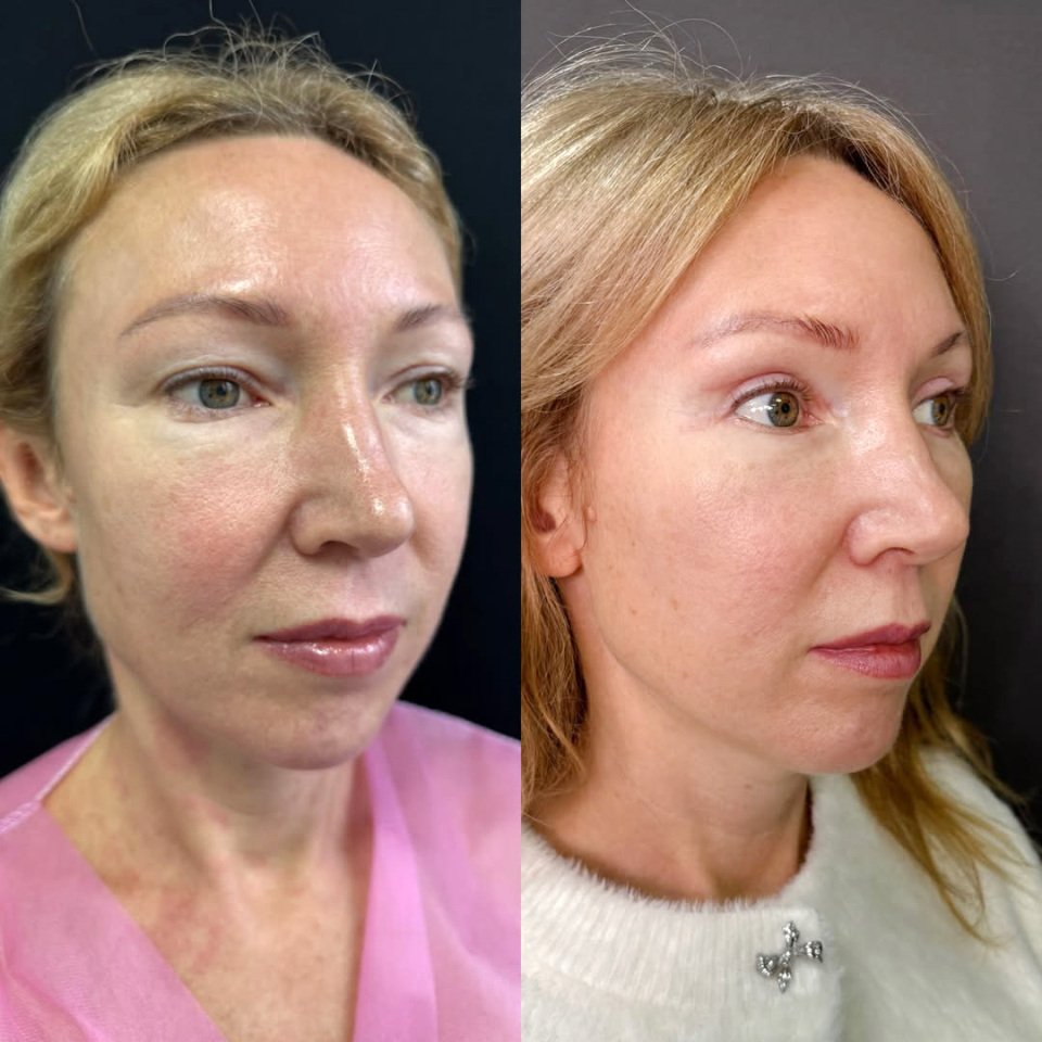 Эндоскопическая подтяжка лица результат через 2 месяца, фотография 2