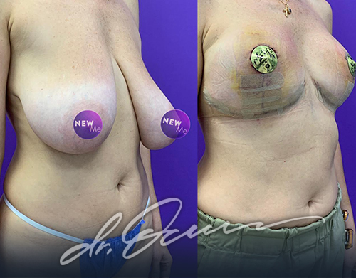Подтяжка груди  — хирург Осин М.А. 23.05.2020, фотография 1