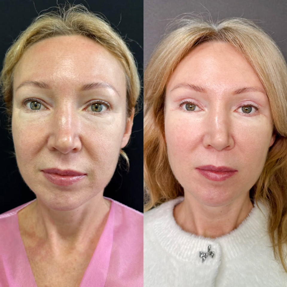Эндоскопическая подтяжка лица результат через 2 месяца, фотография 3