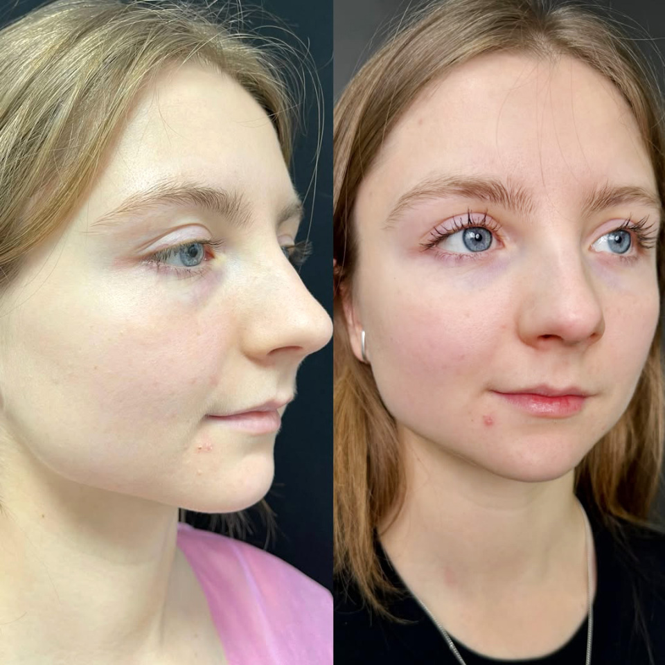 Пластика нижних век для молодой пациентки, фотография 2