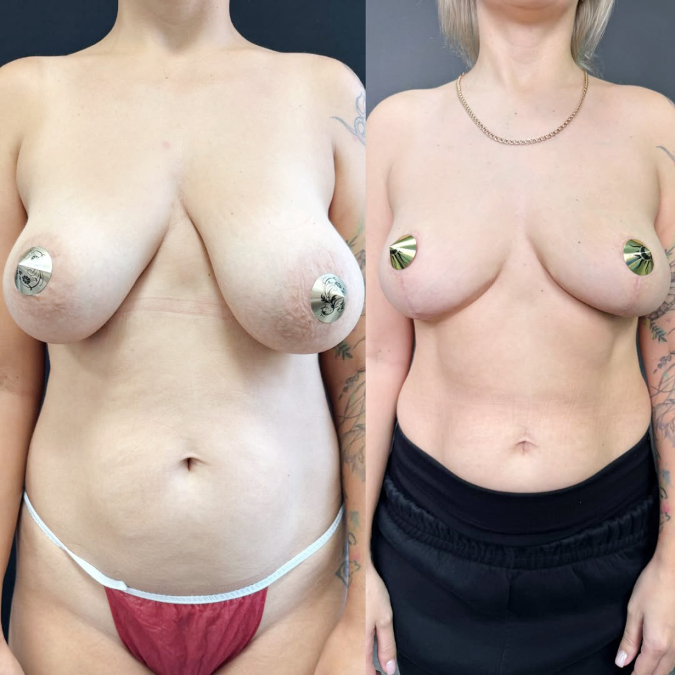 Коррекция асимметрии груди, до и после, фотография 1