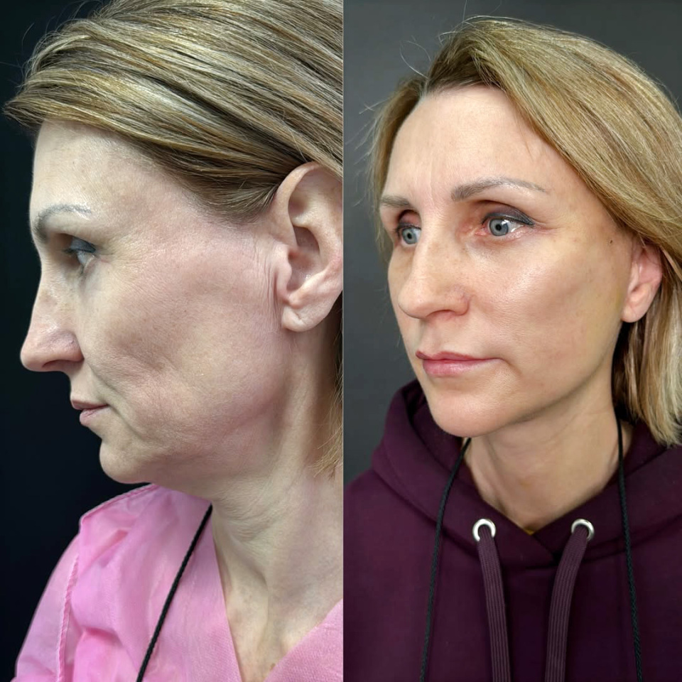 Комплексная операция по омоложению лица, фотография 2