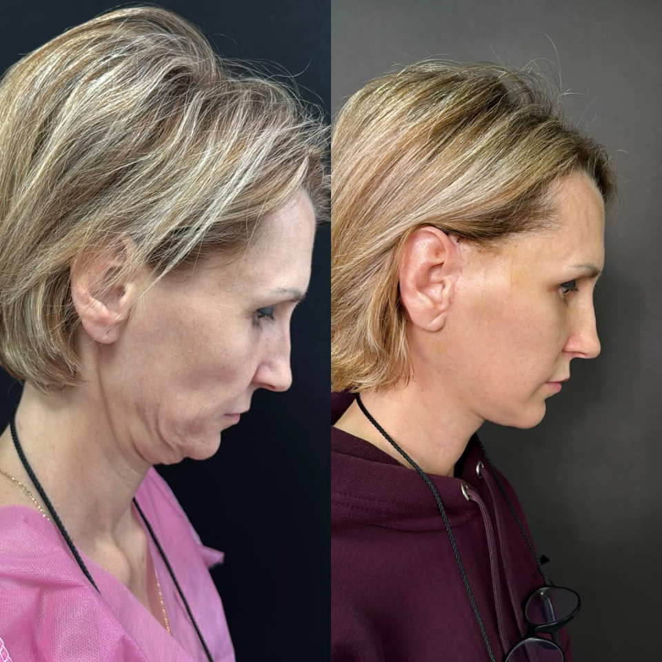 Комплексная операция по омоложению лица, фотография 3