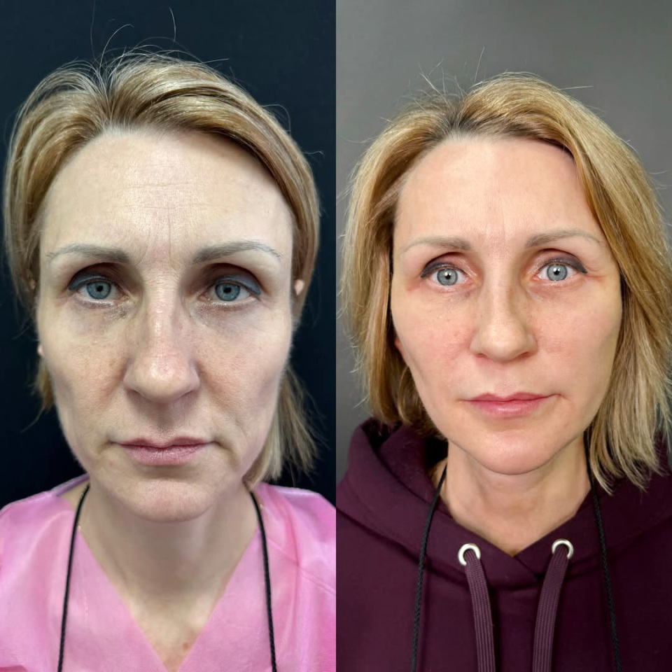 Комплексная операция по омоложению лица, фотография 4