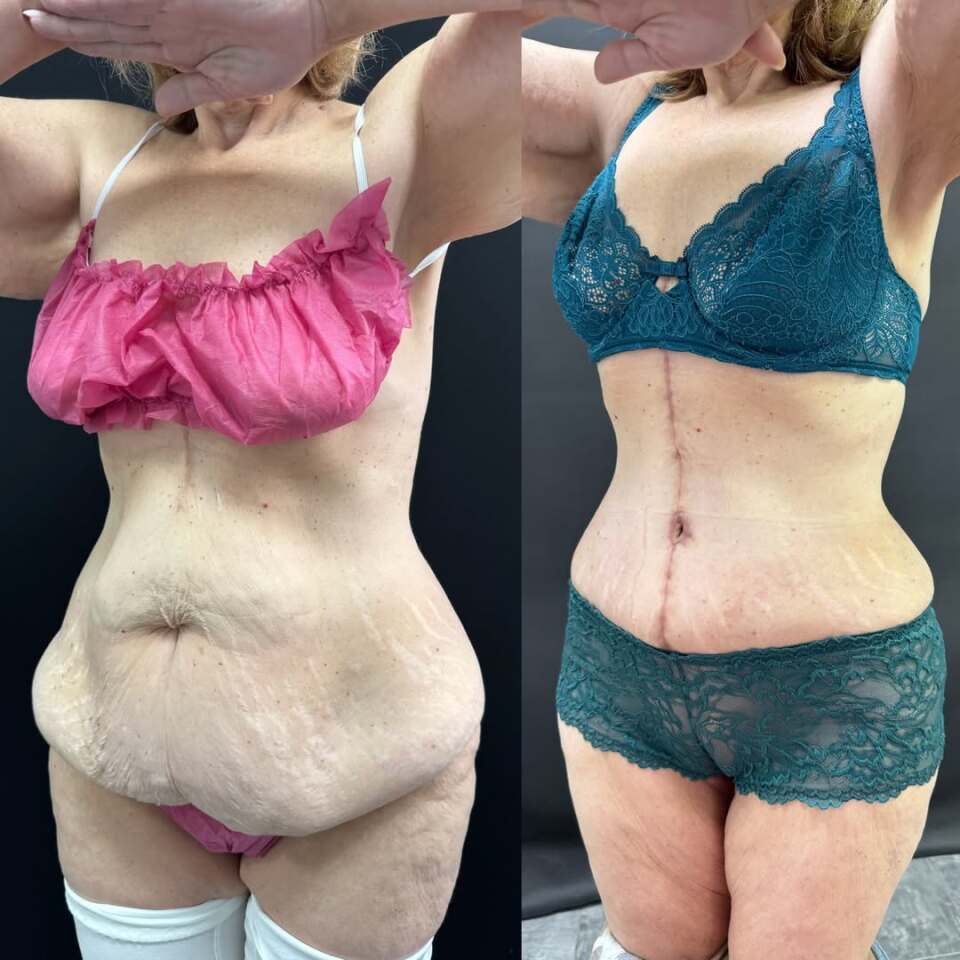 Пластика живота после бариатрической операции, фотография 1