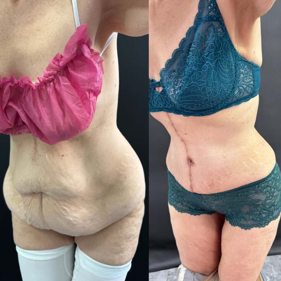 Пластика живота после бариатрической операции, фотография 2