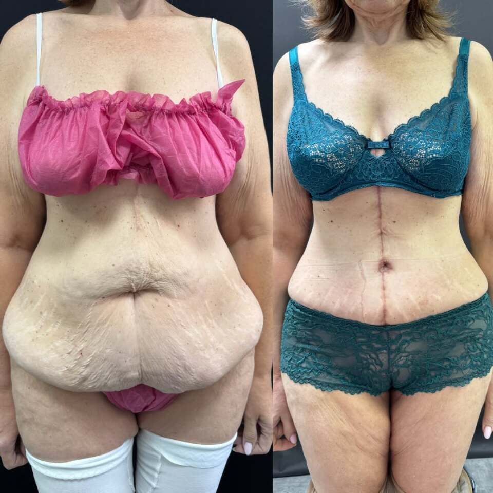 Пластика живота после бариатрической операции, фотография 3